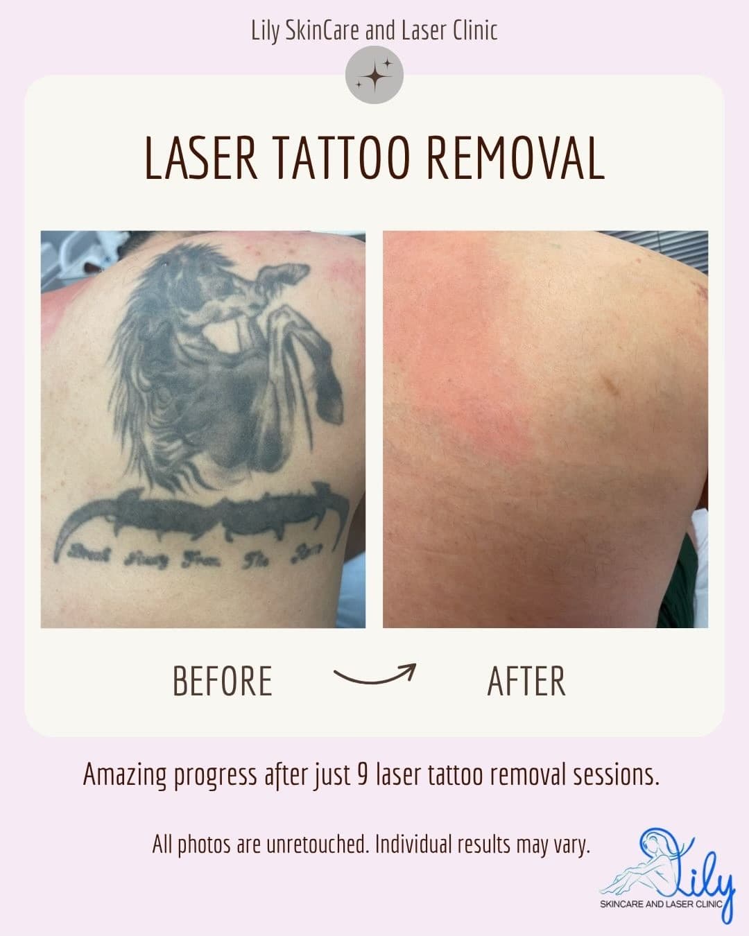 Before and after laser tattoo removal in Vienna VA: a large black horse tattoo on the upper back nearly cleared after 9 sessions at Lily Skincare & Laser Clinic
