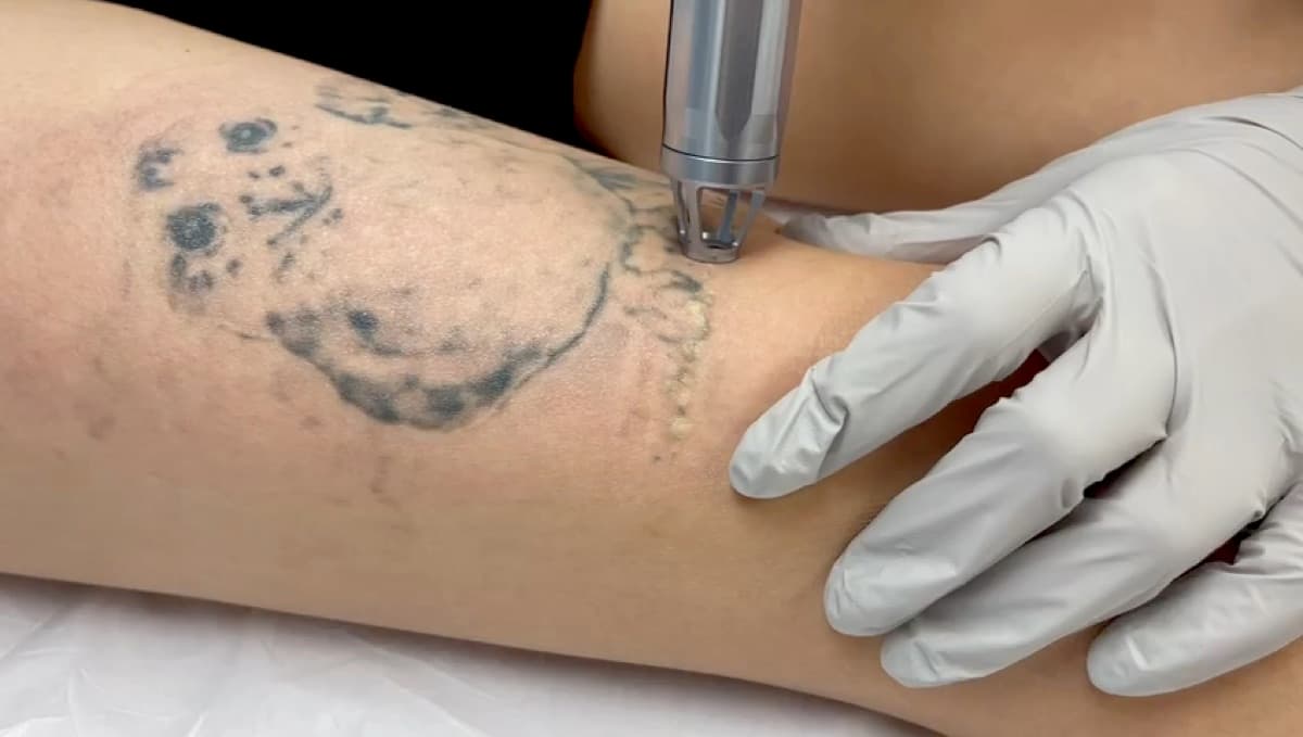 Laser tattoo removal treatment in progress on a client at Lily Skincare & Laser Clinic in Vienna, VA